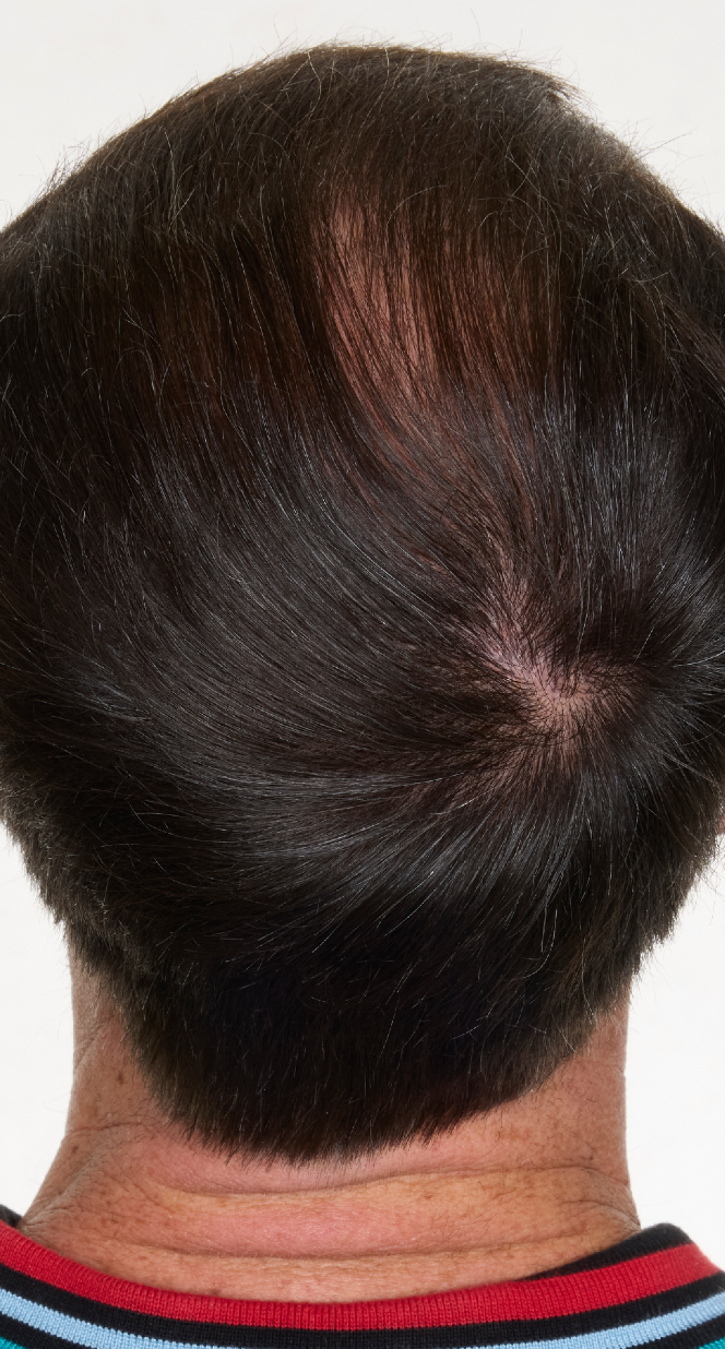 hair-men-result-1-after.png
