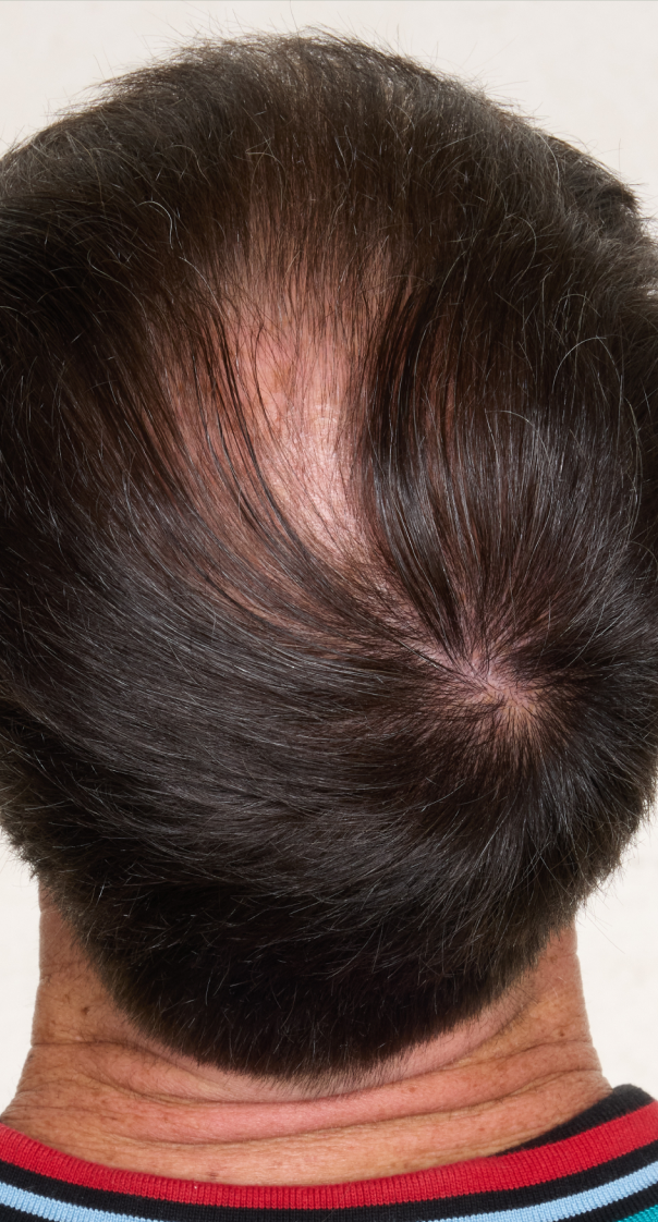 hair-men-result-1-before.png
