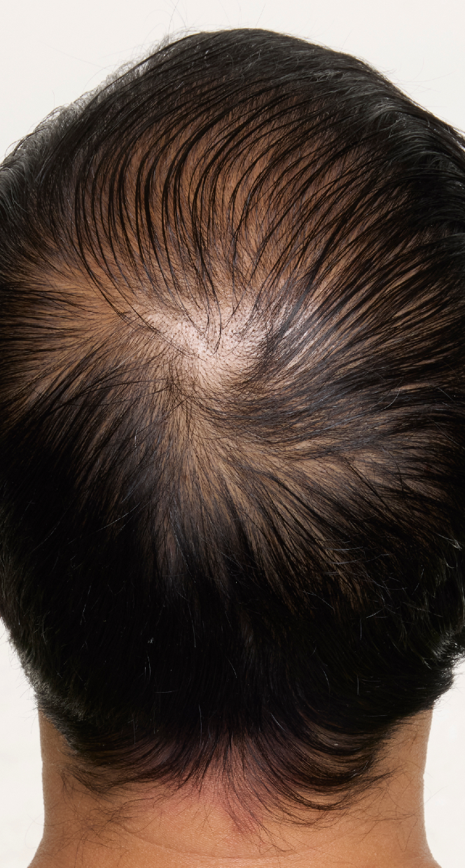 hair-men-result-2-before.png
