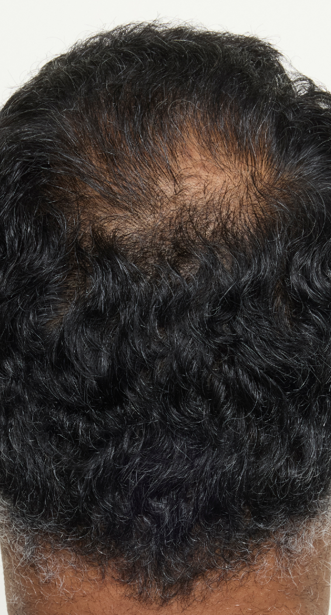 hair-men-result-3-before.png