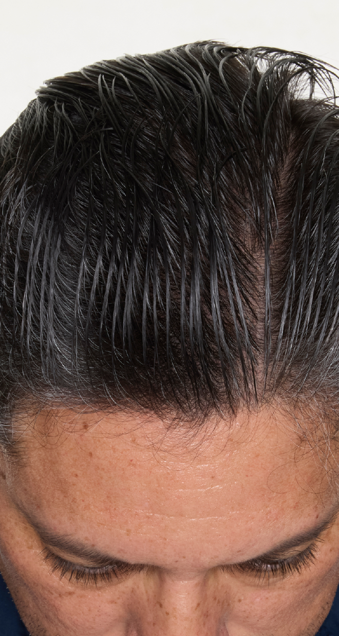 hair-men-result-4-after.png