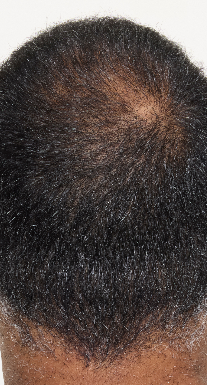 hair-men-result-3-after.png