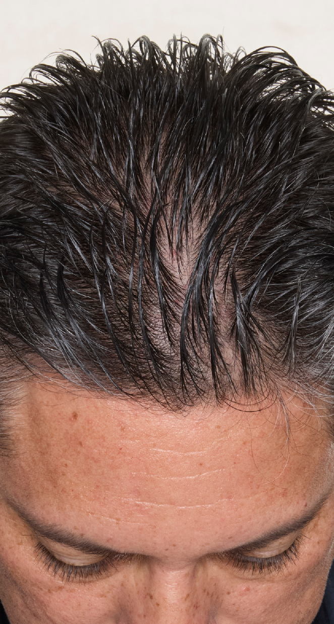 hair-men-result-4-before.png